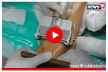 भाजलेल्या रुग्णांना नवं आयुष्य देणारं त्वाचादान, काय आहे ते करण्याची पद्धत? पाहा Video भाजलेल्या रुग्णांना नवं आयुष्य देणारं त्वाचादान, काय आहे ते करण्याची पद्धत? पाहा Video