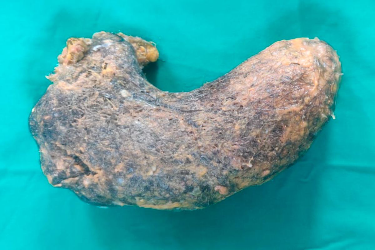 स्वत:चेच केस ओढून खात होती चिमुरडी, डॉक्टरांनी पोटातून काढला तब्बल 100 ग्रॅम गोळा!