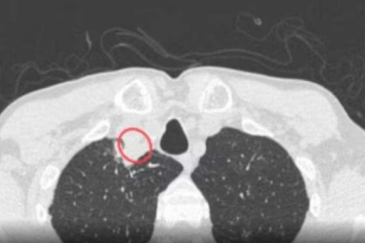 प्लांट फंगल डिसीज