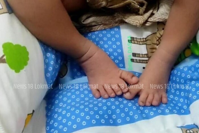 न्यूज 18 ने संपर्क साधला तेव्हा या बाळाच्या पालकांनी सांगितले की, असाधारण बाळाचा जन्म ही त्यांच्यासाठी देवाची भेट आहे. रावली म्हणाली की ती त्याला राजकुमाराप्रमाणे ठेवेल.
