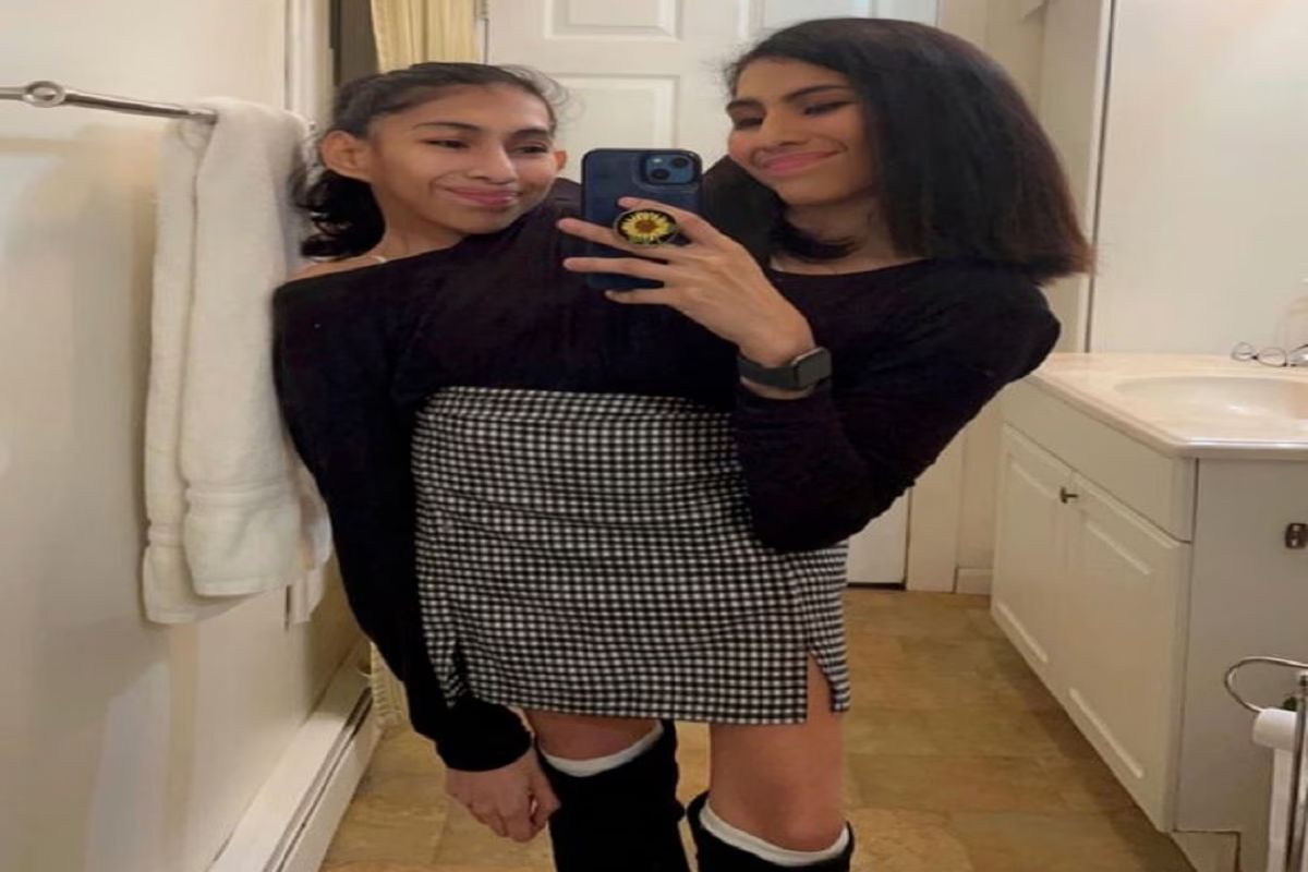 कमरेत जोडल्या गेल्यात जुळ्या बहिणी