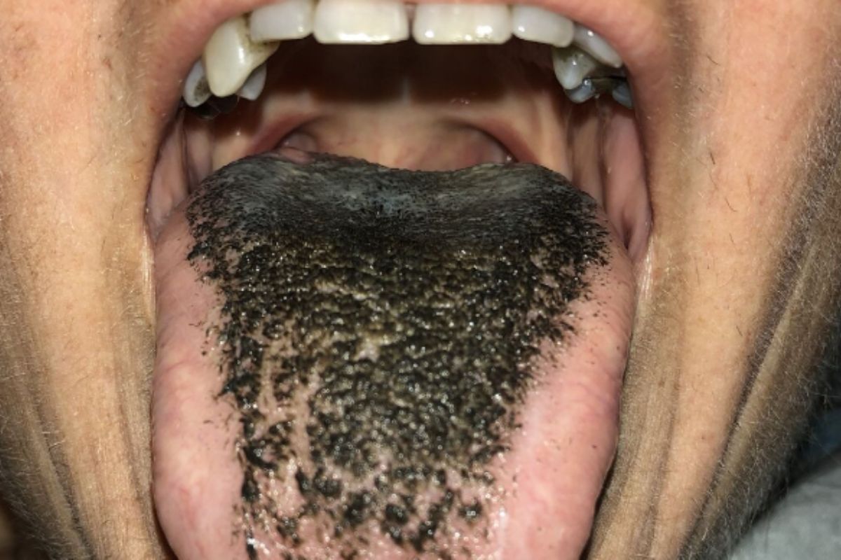 महिलेच्या जिभेवर आले केस