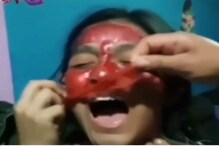 फेस मास्क वापरताय सावधान! तरुणीची भयंकर अवस्था; VIDEO पाहूनच हादराल