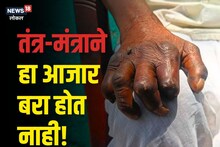 Latur News: पाप-पुण्यामुळे हा आजार झाला नाही; ना तो नवस फेडण्यामुळे होऊ शकतो बरा, सविस्तर वाचा इथं! Video