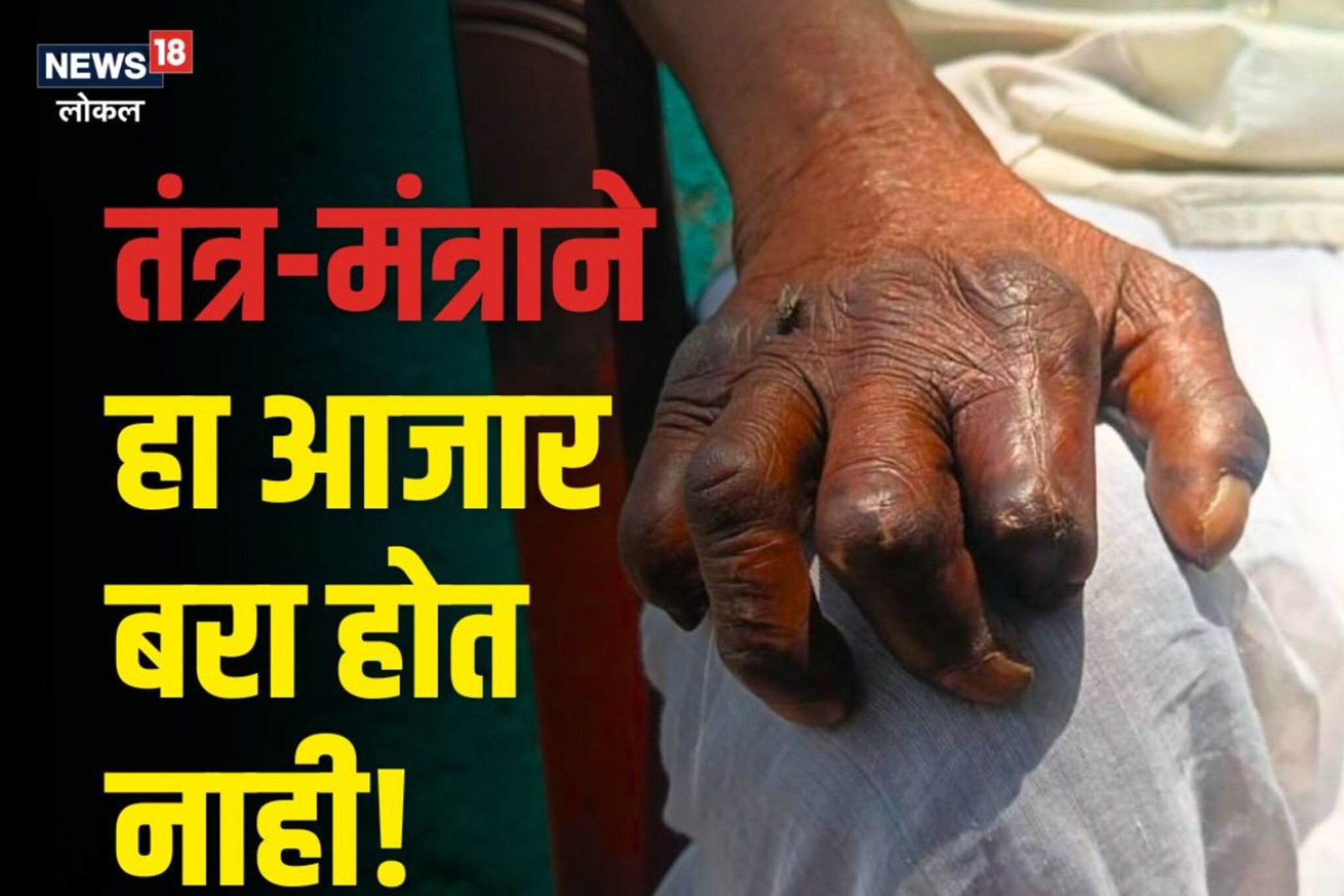 पाप-पुण्यामुळे हा आजार झाला नाही; ना तो नवस फेडण्यामुळे होऊ शकतो बरा, Video