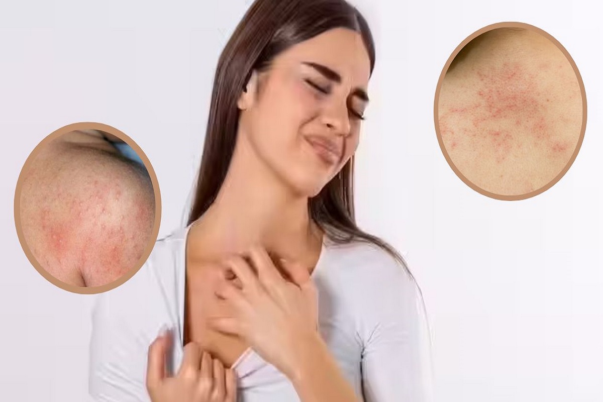 उन्हाळ्यात घामोळ्यांनी त्रस्त आहात? मग हे 5 घरगुती उपाय ठरतील फायदेशीर