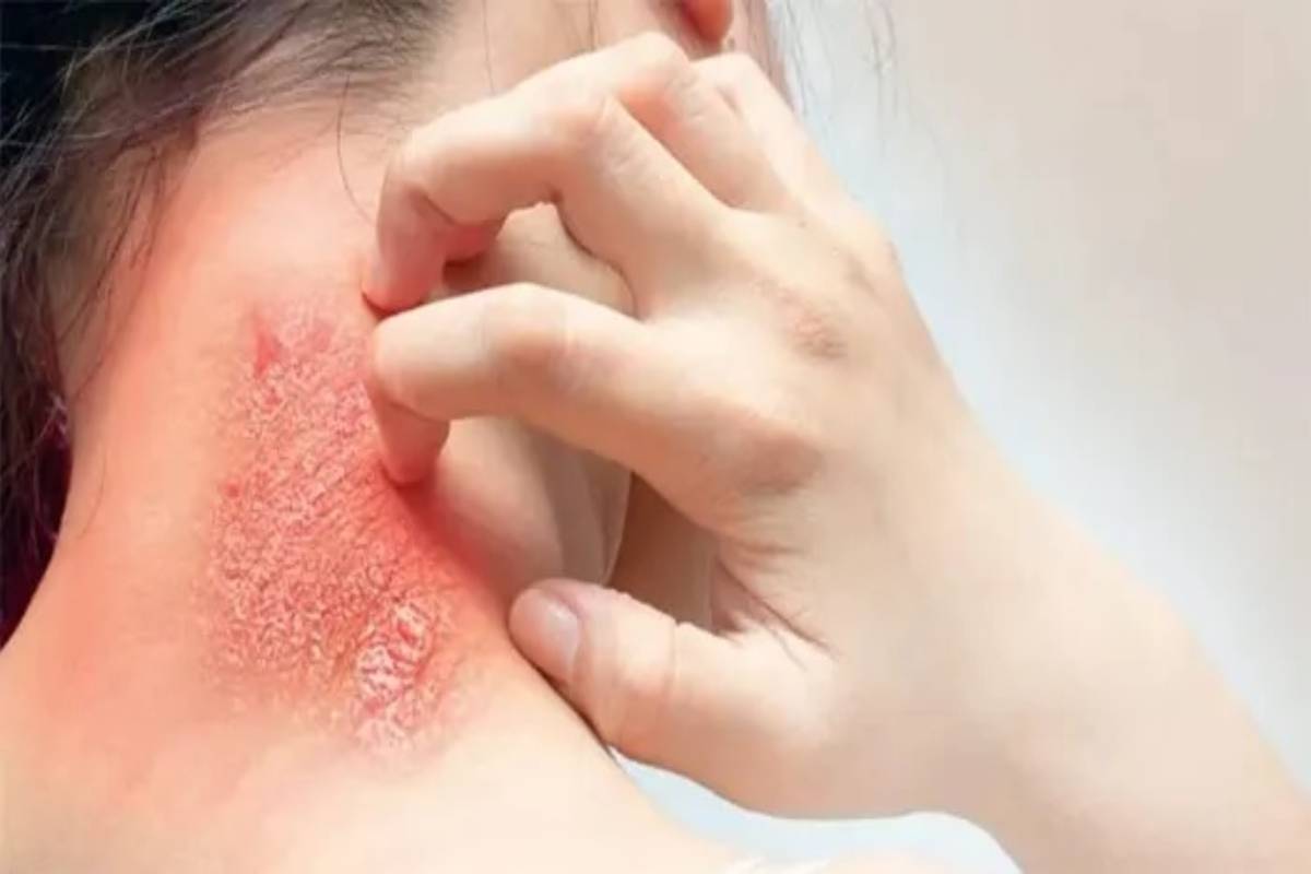 पावसाळ्यात फंगल इंफेक्शनने त्रस्त आहात? मग या घरगुती उपायांनी मिळेल आराम