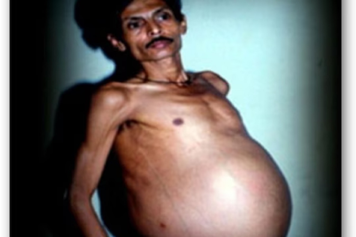 प्रेग्नंट पुरुष (फोटो - रेडिट)