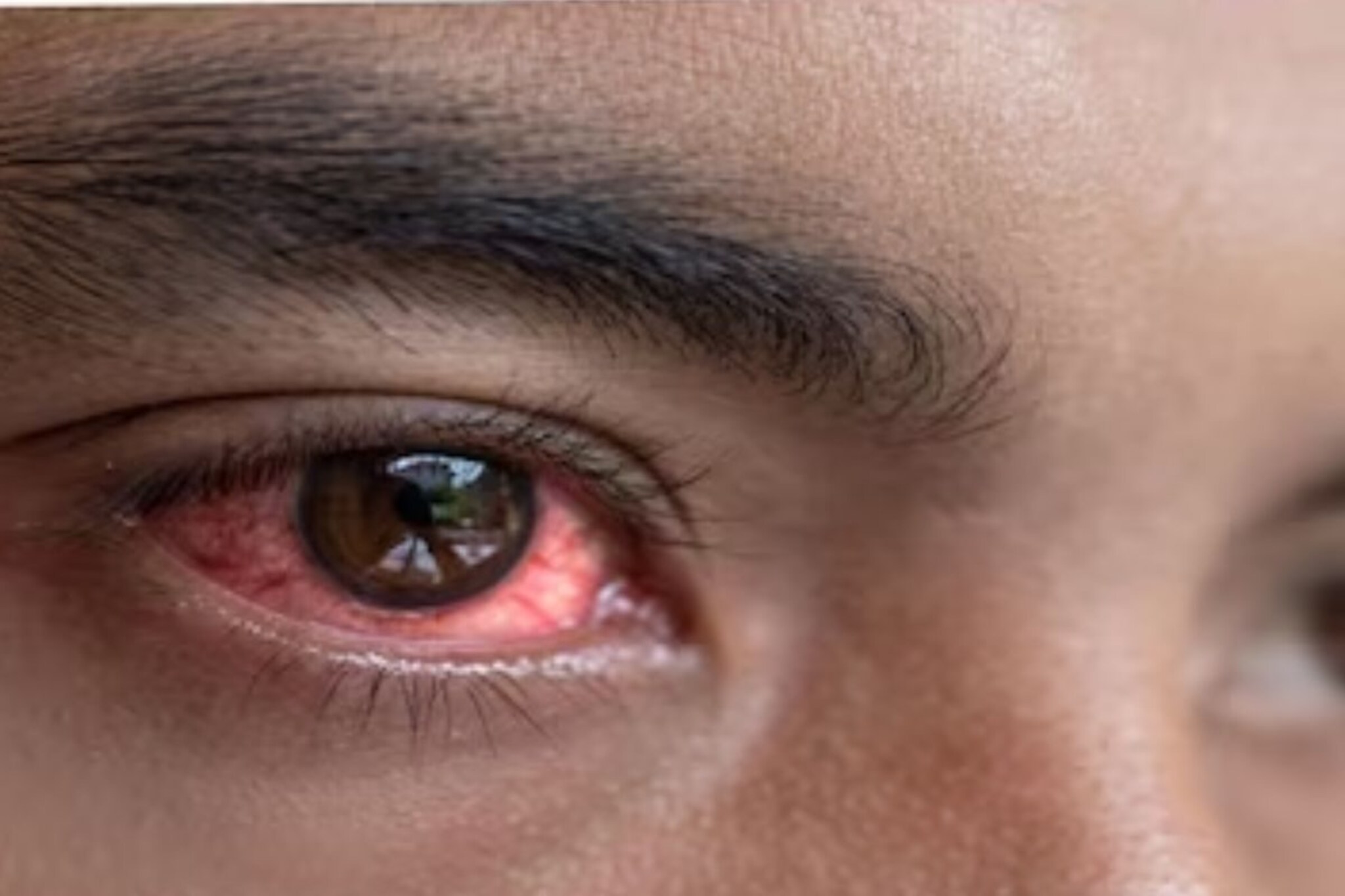 Eye Flue : पावसाळ्यात वाढतो आय फ्लूचा धोका, ही 5 लक्षणं दिसल्यास वेळीच व्हा सावध