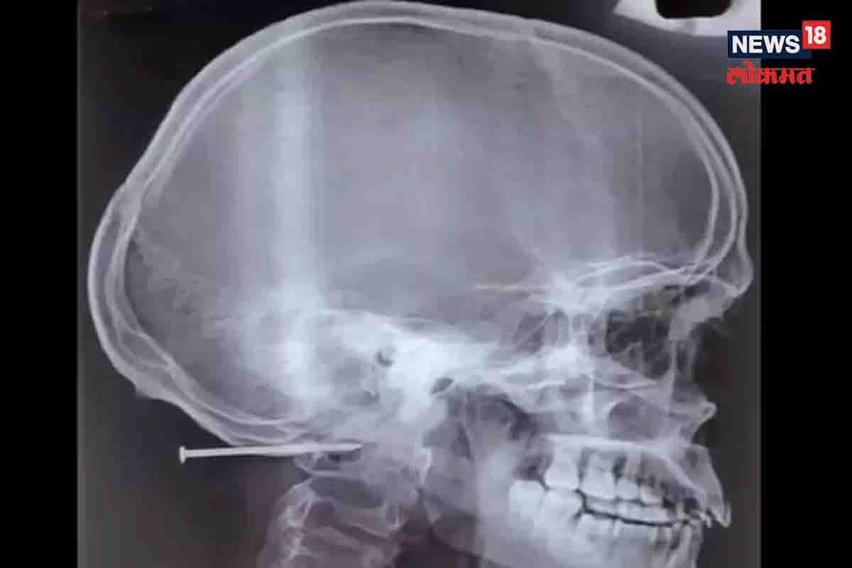 2 इंच खिळा शिरला डोक्यात