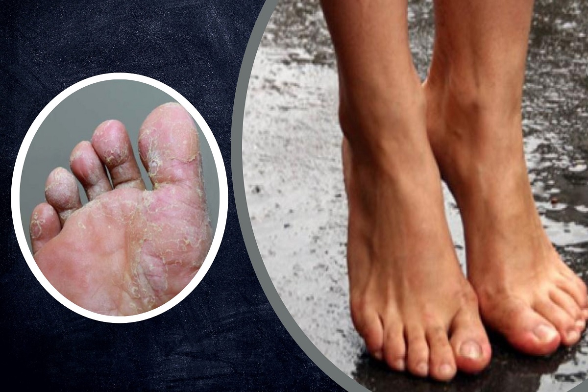 पावसाळ्यात पायांना फंगल इंफेक्शनचा धोका! 5 उपाय करा समस्येपासून दूर राहा