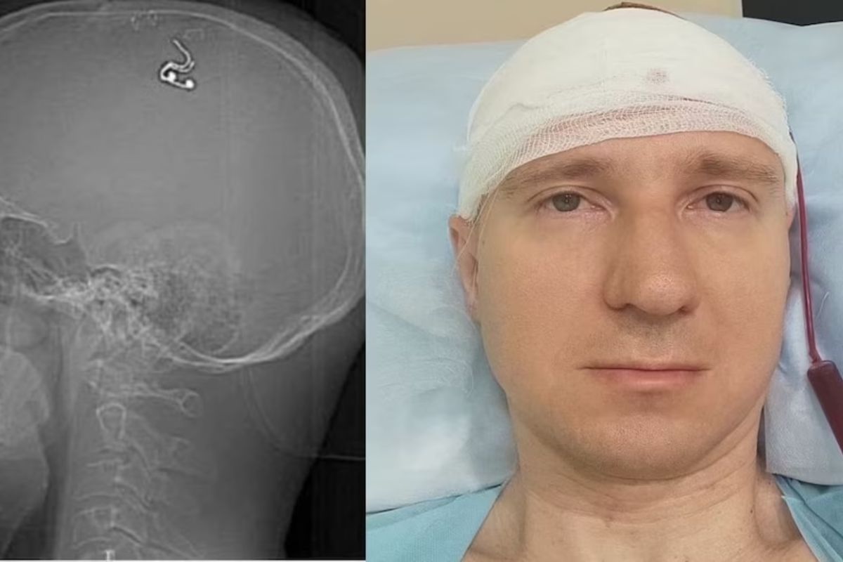 शास्त्रज्ञाने स्वतःच्या मेंदूची केली शस्त्रक्रिया