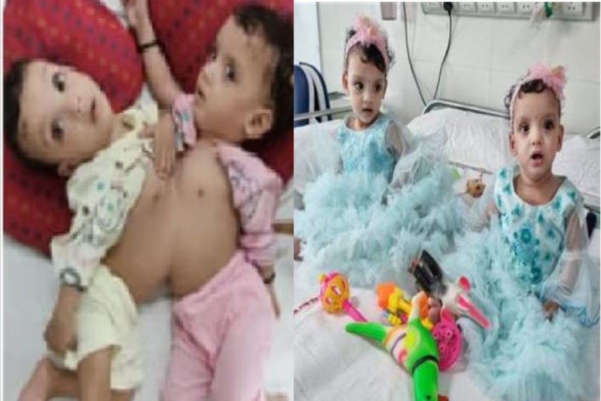 जुळ्या बहिणींना केलं वेगळं