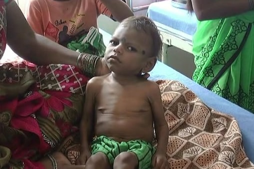 ಅಪೌಷ್ಠಿಕತೆಯಿಂದ ಬಳಲುತ್ತಿರುವ ಮಗು