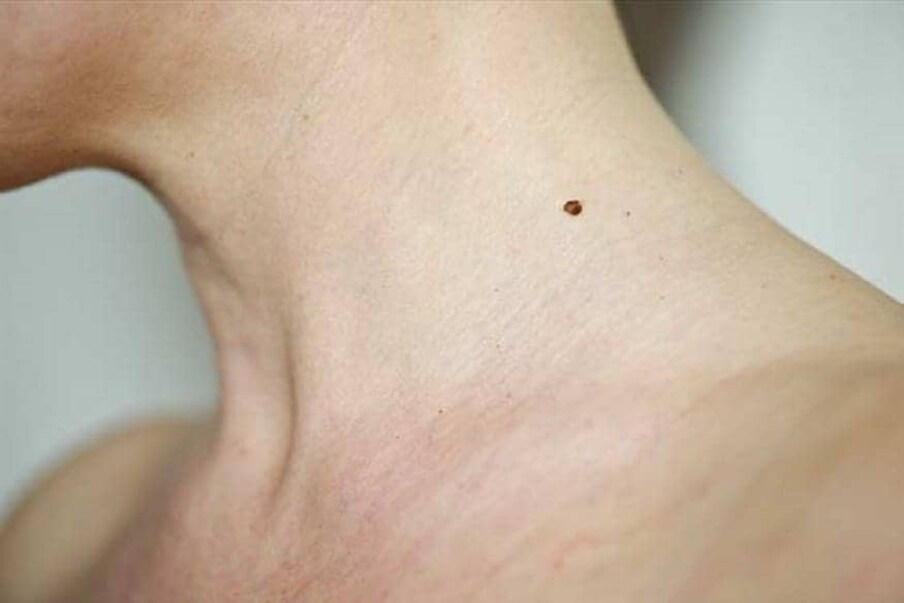 Moles On Body: ನಿಮಗೆ ಅಲ್ಲಿ ಮಚ್ಚೆ ಇದೆಯಾ ...