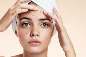 Pimples Remedy: ಮೇಕಪ್ ಮಾಡಿ ಮುಖದ ಮೇಲೆ ಮೊಡವೆ ಆಗಿದ್ರೆ ಇಲ್ಲೊಂದು ಹ್ಯಾಕ್ಸ್​ ಇದೆ