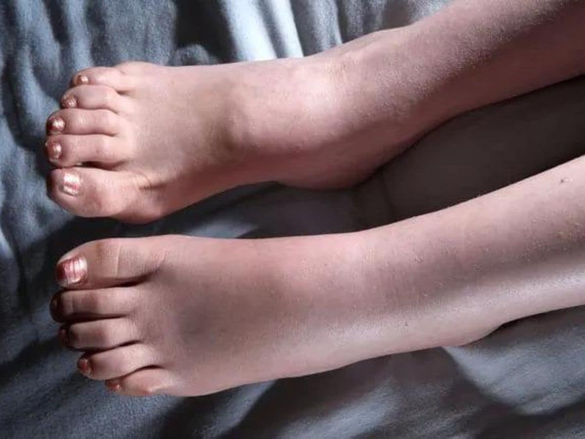 ಚಳಿಗಾಲದಲ್ಲಿ ಕೈಕಾಲು ಊದಿಕೊಂಡರೆ ಭಯಪಡಬೇಡಿ; ಜಸ್ಟ್ ಈ ಟಿಪ್ಸ್ ಫಾಲೋ ಮಾಡಿ! how