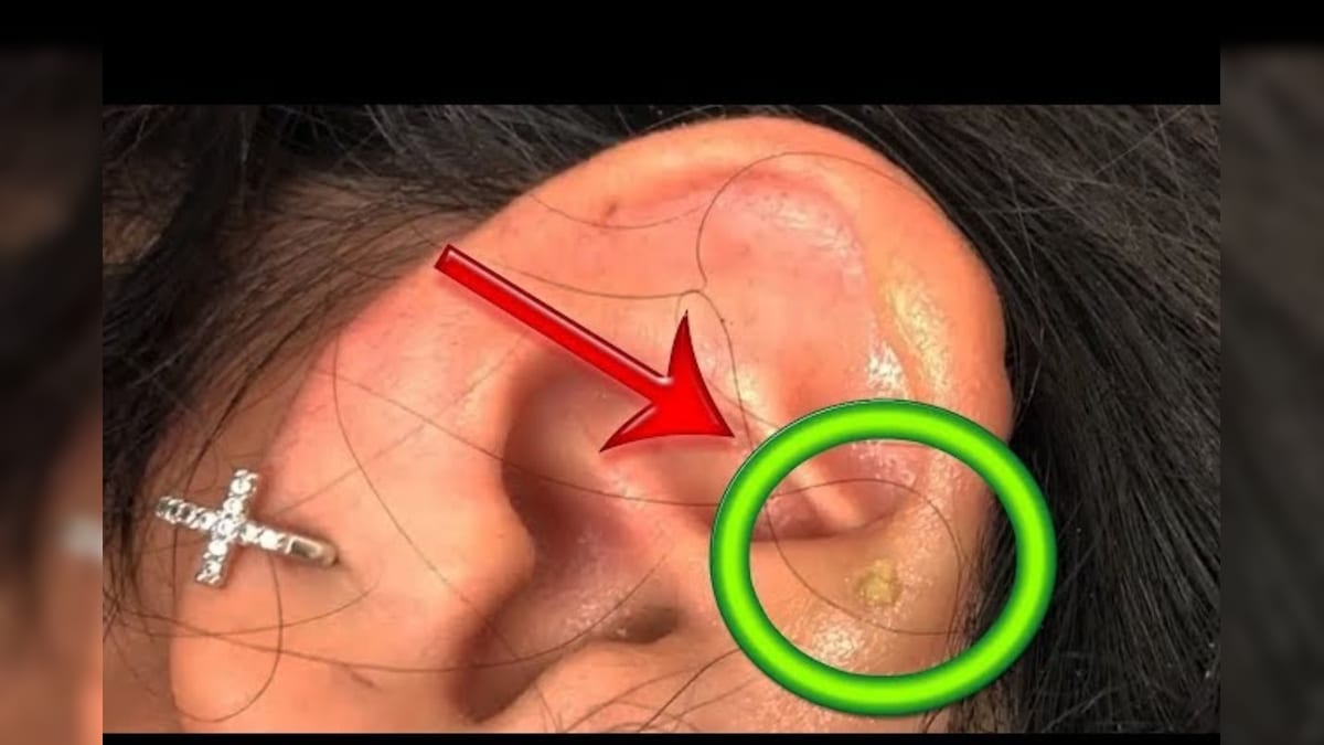 ಕಿವಿಯಲ್ಲಿ ಮೊಡವೆಗಳಾಗಿವೆಯೇ? ಇದಕ್ಕೆ ಸಿಂಪಲ್ ಮನೆಮದ್ದು ಇಲ್ಲಿದೆ | Pimples in