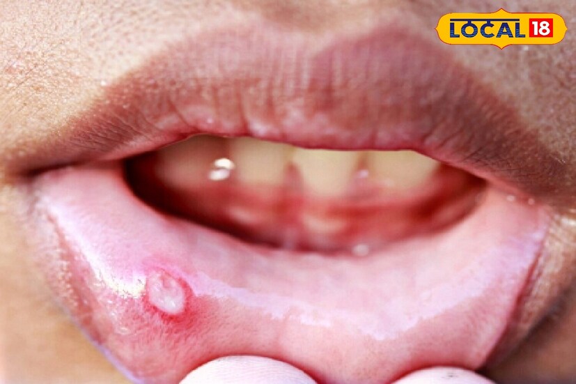 Mouth Ulcer Remedy: ಬಾಯಿ ಹುಣ್ಣಿನಿಂದ ಆಹಾರ ತಿನ್ನೋಕೆ ಆಗ್ತಿಲ್ವಾ? ಈ ಮನೆಮದ್ದು ...