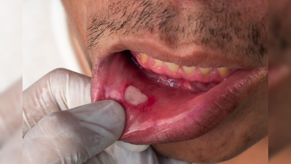 Mouth Ulcer Remedy: ಬಾಯಿ ಹುಣ್ಣಿನಿಂದ ಆಹಾರ ತಿನ್ನೋಕೆ ಆಗ್ತಿಲ್ವಾ? ಈ ಮನೆಮದ್ದು