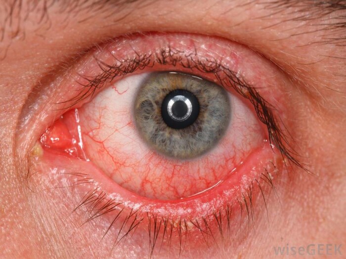 How Does High Blood Pressure Affect Your Eyes