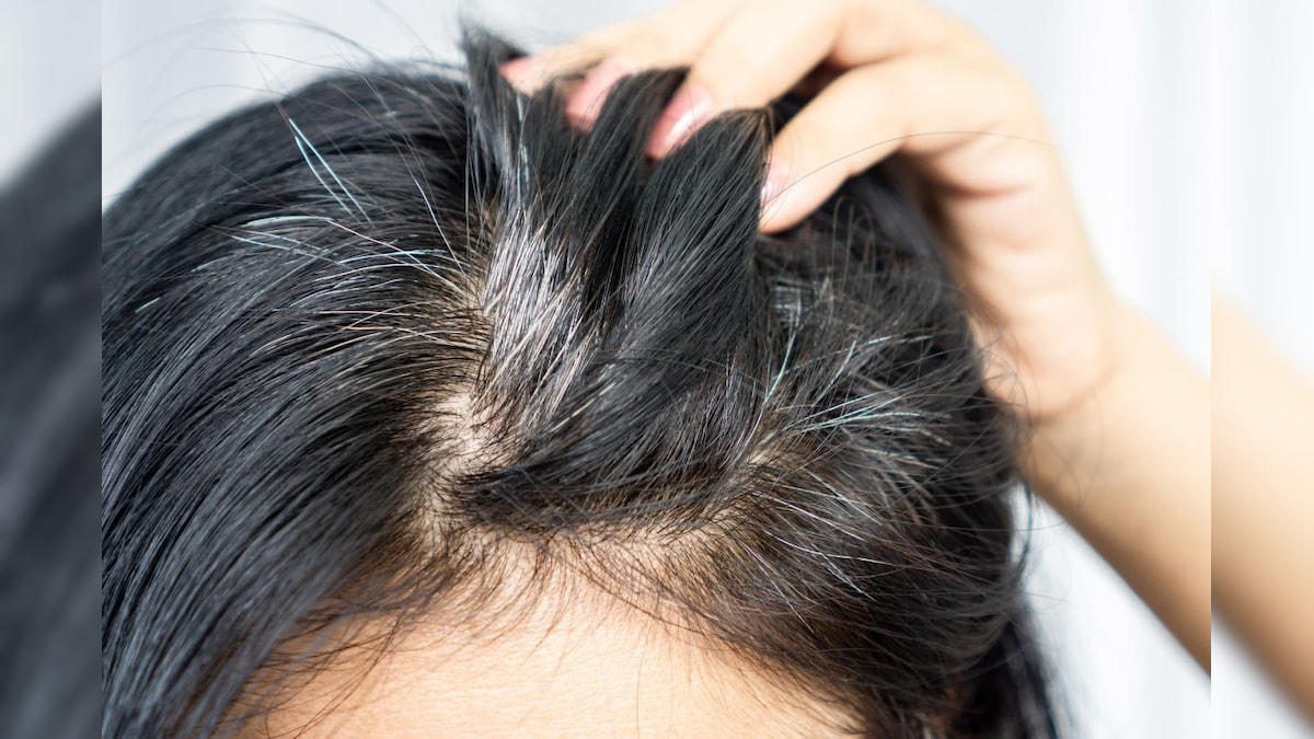 Dandruff: ತಲೆಹೊಟ್ಟನ್ನಾ ನಿರ್ಲಕ್ಷಿಸುತ್ತಿದ್ದೀರಾ? ಈ 4 ಗಂಭೀರ ಸಮಸ್ಯೆಗಳು ನಿಮ್ಮ ನಿದ್ದೆಗೆಡಿಸಬಹುದು ಎಚ್ಚರ!