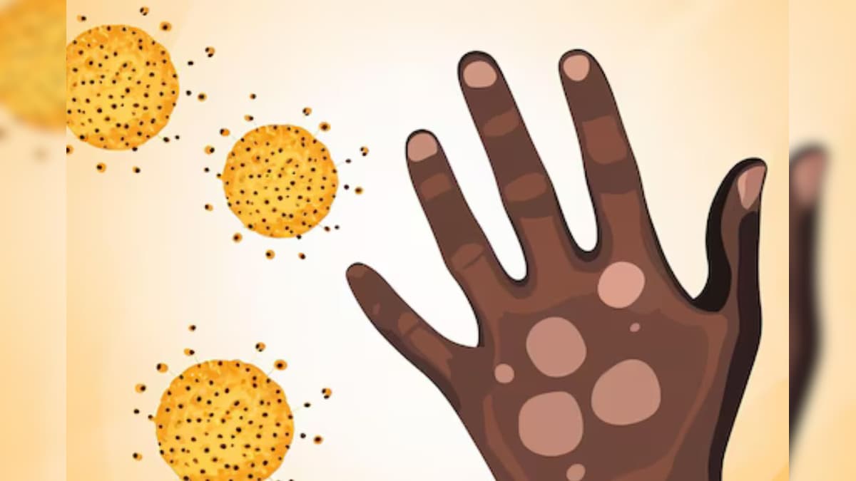 Health Care: ಕುಷ್ಟ ರೋಗಕ್ಕೆ ಆಯುರ್ವೇದಲ್ಲಿದೆ ಔಷಧಿ; ಈ ಗಿಡಮೂಲಿಕೆಗಳೇ ಸಂಜೀವಿನಿ!