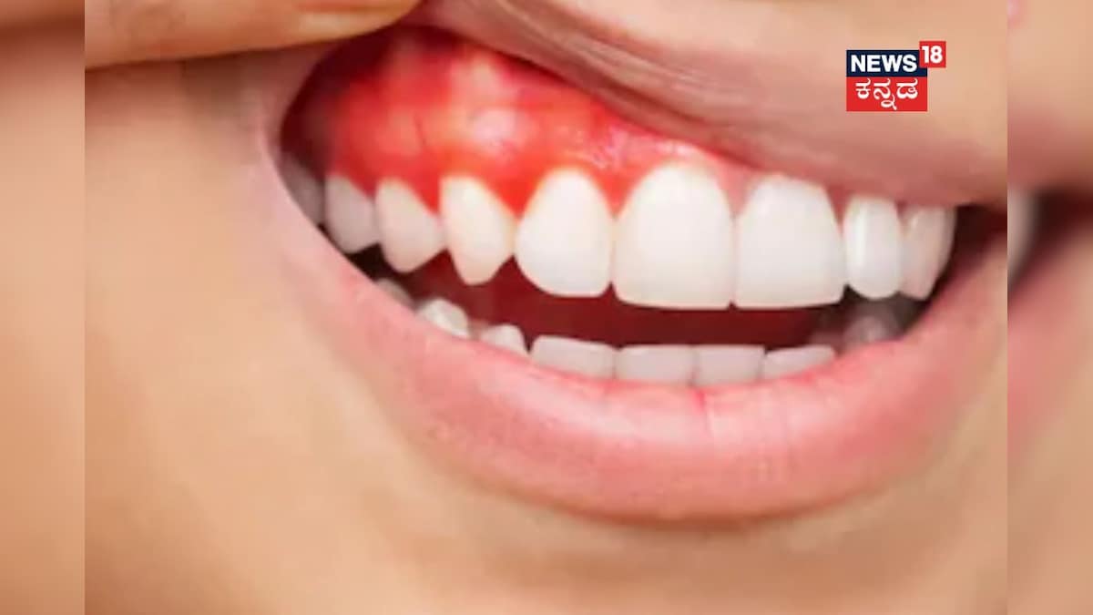 Bleeding Gums: ವಸಡಿನಲ್ಲಿ ರಕ್ತಸ್ರಾವ ಆಗುತ್ತಾ? ಹಾಗಾದ್ರೆ, ನೀವು ಬ್ರಶ್ ಮಾಡೋ ರೀತಿ ಹೀಗಿರಬೇಕು