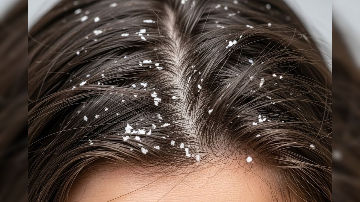 Home Remedies: ತಲೆಹೊಟ್ಟಿನಿಂದ ಬೇಸತ್ತಿದ್ದೀರಾ? ಡೋಂಟ್ ವರಿ, ಈ ಆಯುರ್ವೇದ ಟಿಪ್ಸ್ ಫಾಲೋ ಮಾಡಿ ಸಾಕು!