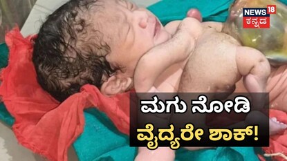ಮಗು ನೋಡಿ ವೈದ್ಯರೇ ಶಾಕ್​!