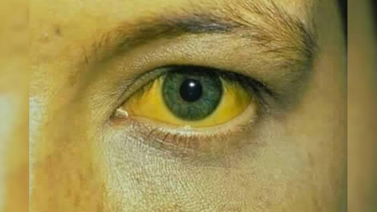 jaundice spread in kottayam district News18 Malayalam