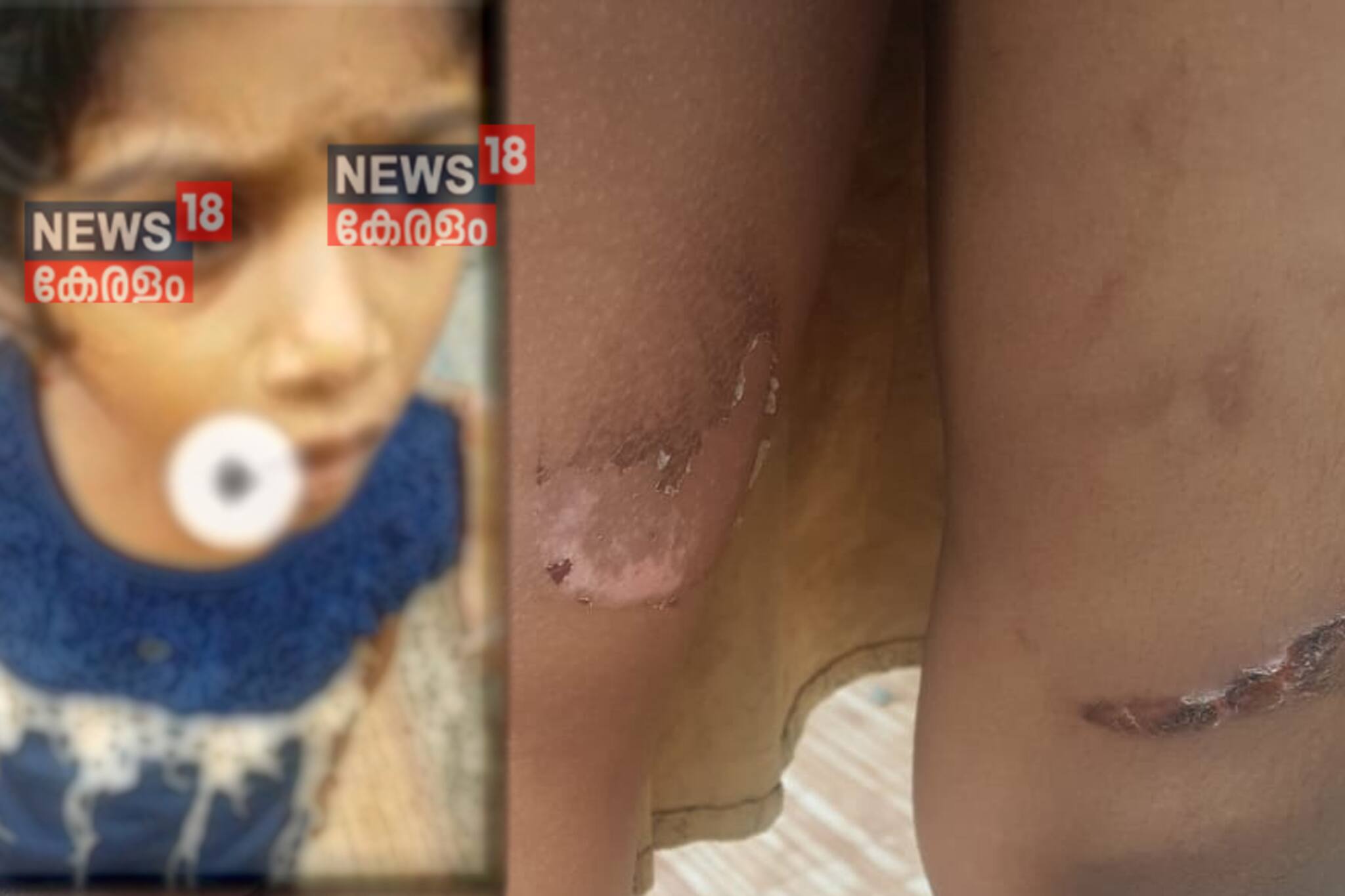 രണ്ടാം ക്ലാസുകാരിയെ രണ്ടാനമ്മ പൊള്ളിച്ചത് പുറത്തറിയിച്ച അധ്യാപികയെ പുറത്താക്കി