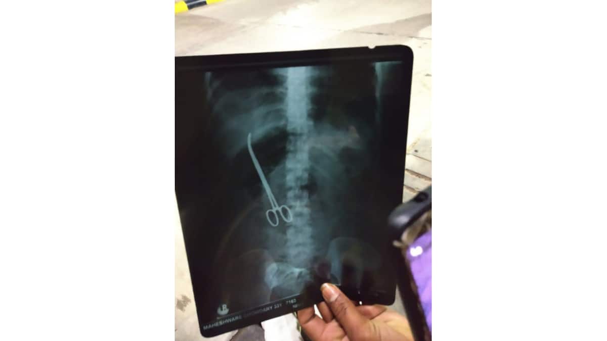 യുവതിയുടെ വയറില്‍ ശസ്ത്രക്രിയ ഉപകരണം; തിരിച്ചറിഞ്ഞത് 2 മാസങ്ങള്‍ക്ക്