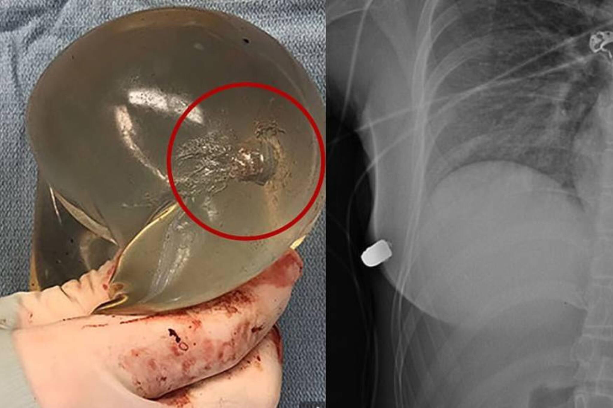 വെടിയുണ്ട മാറിൽക്കൊണ്ടു; കൃത്രിമസ്തനം യുവതിയുടെ ജീവൻ രക്ഷിച്ചു