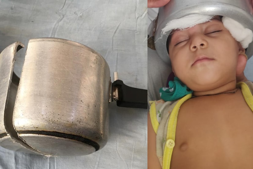  രാജ്കോട്ട്: കളിക്കുന്നതിനിടെ ഒരു വയസുള്ള പെൺകുഞ്ഞിന്റെ തല അബദ്ധത്തിൽ കുക്കറിനുള്ളിൽ കുടുങ്ങി. രാജ്കോട്ടിലെ ഭാവ്നഗറിലാണ് സംഭവം ഉണ്ടായത്.