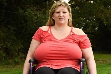 സ്തനങ്ങളുടെ ഭാരം താങ്ങാനാവാതെ ജീവിതം വീൽ ചെയറിലായി ഒരു യുവതി