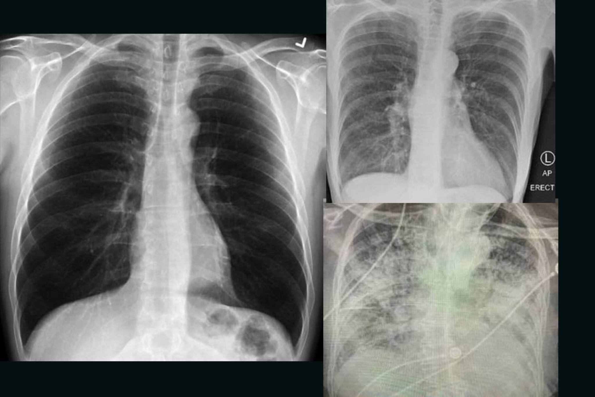 പുകവലിക്കാരുടെ ശ്വാസകോശത്തെക്കാൾ മോശമാണ് കോവിഡ് ബാധിച്ചവരുടെ ശ്വാസകോശം