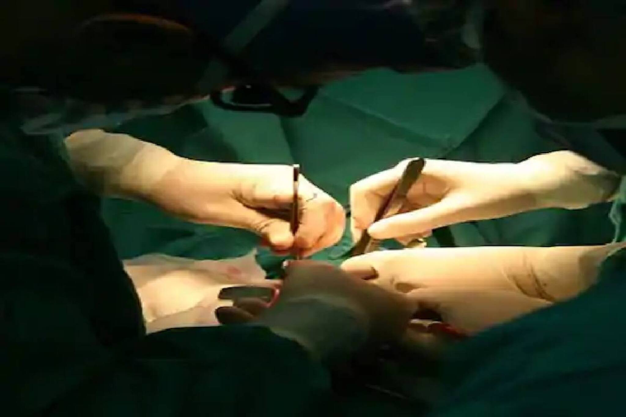 ലിംഗ മാറ്റ ശസ്ത്രക്രിയയ്ക്ക് വിധേയരായി ലോകത്തിലെ ആദ്യത്തെ ഇരട്ടകൾ