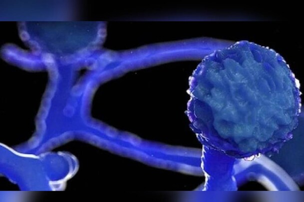 കോഴിക്കോട് സ്വദേശി ബ്ലാക്ക് ഫംഗസ് ബാധിച്ച് മരിച്ചു