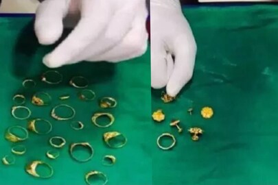 വയറ്റിൽനിന്ന് പുറത്തെടുത്ത സ്വർണം വയറ്റിൽനിന്ന് പുറത്തെടുത്ത സ്വർണം