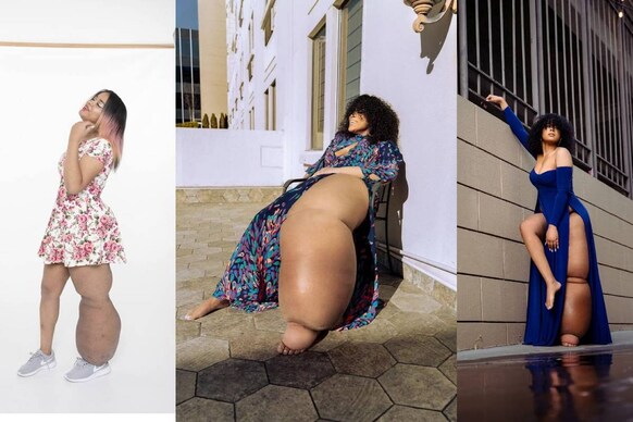 45 കിലോയുള്ള ആ കാല് മുറിച്ചുമാറ്റിക്കൂടെ? ഭിന്നശേഷിക്കാരിയായ മോഡലിനെതിരെ അധിക്ഷേപം