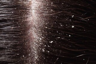 Dandruff 