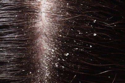 Dandruff Dandruff