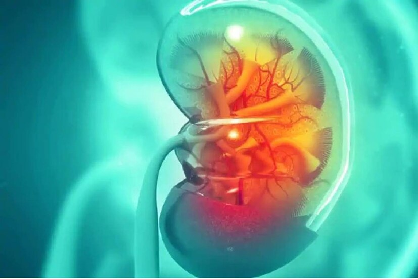 Kidney, Kidney Transplant, Chennai, Madras Medical Mission, വൃക്ക, വൃക്ക മാറ്റിവെയ്ക്കൽ ശസ്ത്രക്രിയ, ചെന്നൈ, മദ്രാസ് മെഡിക്കൽ മിഷൻ