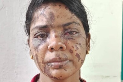 Sheeba_acid-attack
