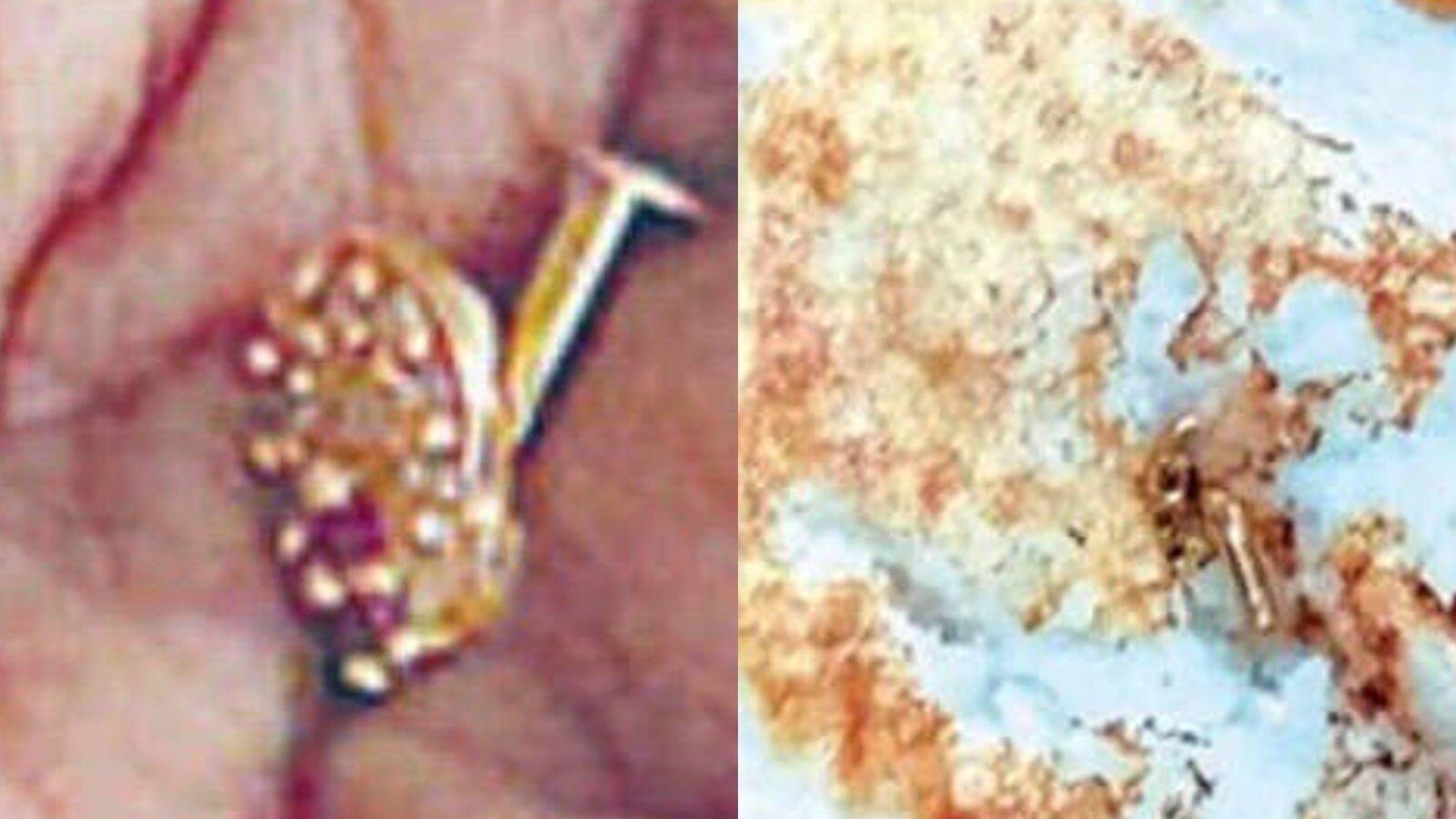 Nose stud സീരിയൽ നടിക്ക് ദോശയിൽ നിന്ന് സ്വർണ മൂക്കുത്തി; ദോശയുണ്ടാക്കിയത് കടയിൽ നിന്ന് വാങ്ങിയ