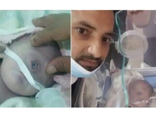 ഒരു കണ്ണുമായി ജനിച്ച കുഞ്ഞ്