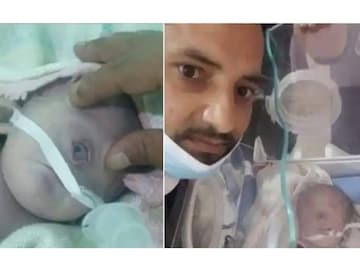 ഒരു കണ്ണുമായി ജനിച്ച കുഞ്ഞ് ഒരു കണ്ണുമായി ജനിച്ച കുഞ്ഞ്