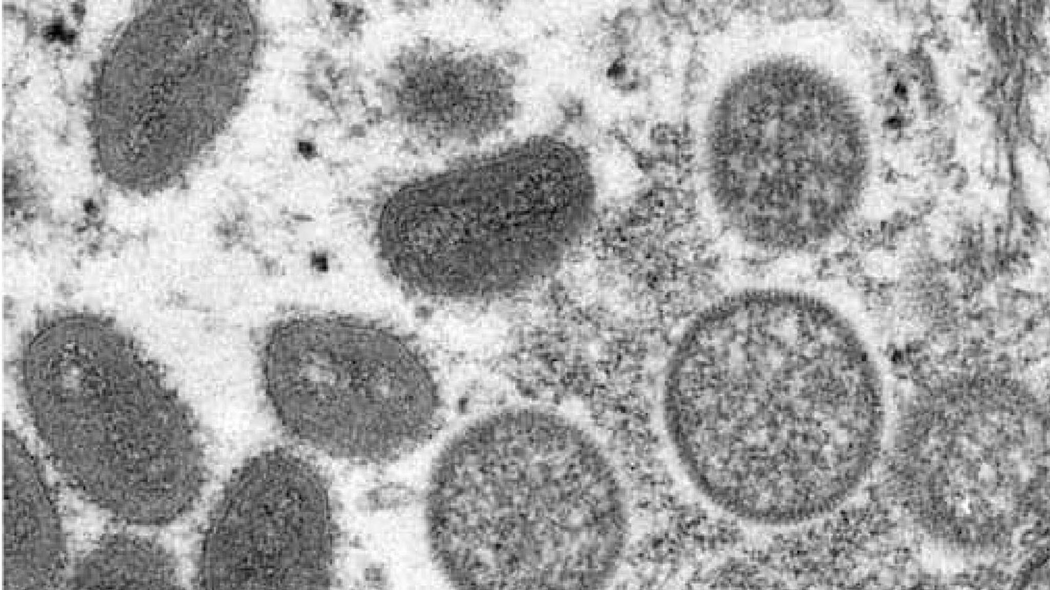 Monkeypox |യു.എ.ഇയില്‍ കുരങ്ങുപനി സ്ഥിരീകരിച്ചു; ആശങ്കപ്പെടേണ്ട സാഹചര്യമില്ലെന്ന് ആരോഗ്യമന്ത്രാലയം