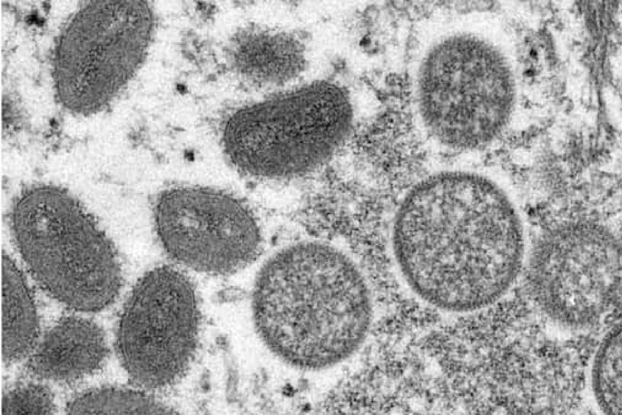 Monkeypox |യു.എ.ഇയില്‍ കുരങ്ങുപനി സ്ഥിരീകരിച്ചു; ആശങ്കപ്പെടേണ്ട സാഹചര്യമില്ലെന്ന് ആരോഗ്യമന്ത്രാലയം